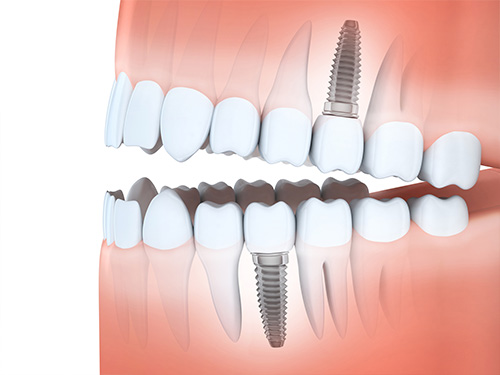 Multiple Tooth Implants