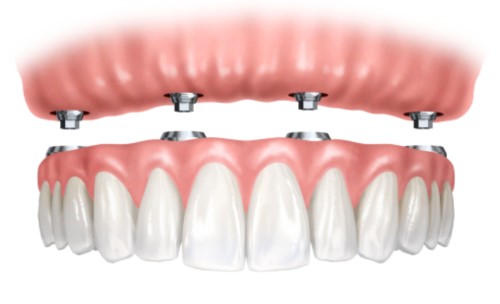 Denture Supported by Implants