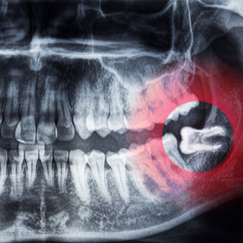 What to Expect When Getting Your Wisdom Teeth Out
