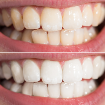 6 Ways Teeth Whitening Can Change Your Life