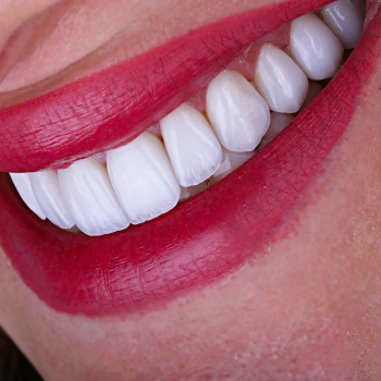 Transform Your Smile With Veneers