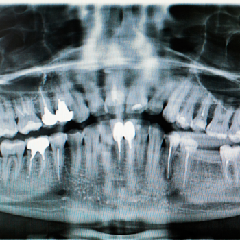 Are Dental X- Rays Safe?