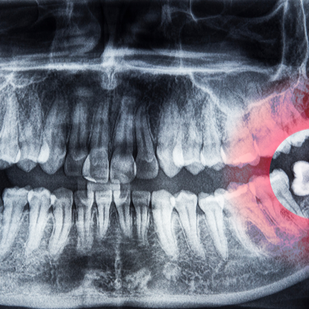 Why Do We Have Wisdom Teeth?