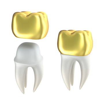 The Benefits Of Dental Crowns & Dental Bridges