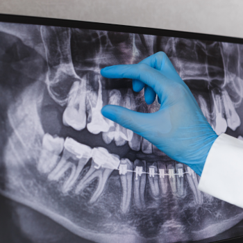 Top Two Signs You Need Root Canal Treatment