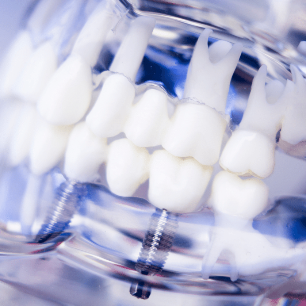 Considering Dental Implants to Transform Your Smile?