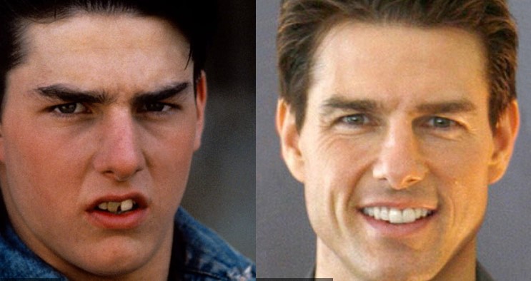 does tom cruise wear dentures